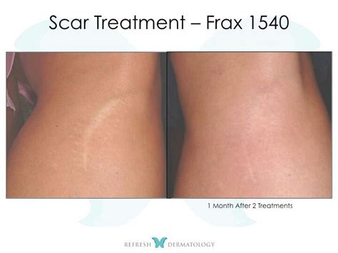 Scar Revision Houston Tx Refresh Dermatology