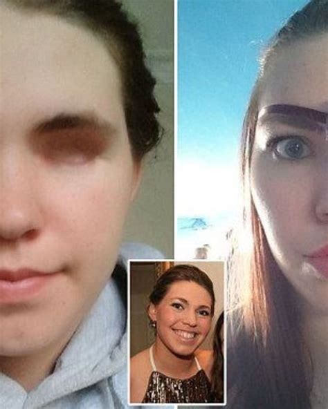 Woman Loses Eye To Rare Form Of Ocular Melanoma Opposing Views My Xxx Hot Girl