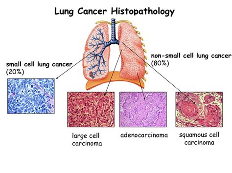 Pathogenesis Of Lung Cancer Signalling Pathways Roadm