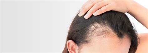 Comme chez les hommes, la perte des cheveux chez la femme (alopécie) est souvent vécue comme une véritable catastrophe, un traumatisme psychologique pratiquement intolérable. Calvitie féminine ou Alopecie androgénique ce que vous devez savoir