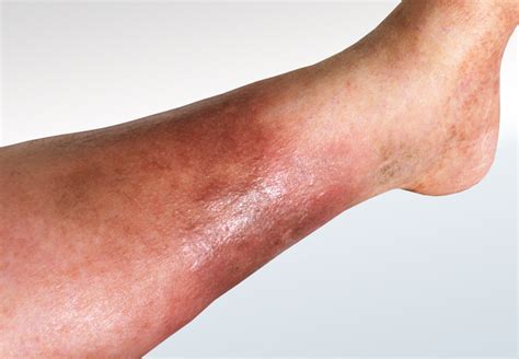 Cellulitis Relieve Foot Pain And Leg Pain