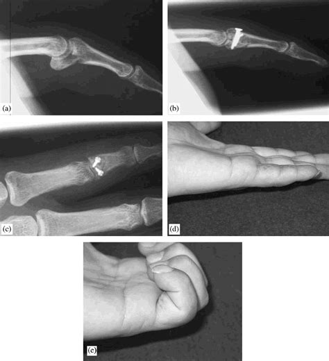 Dorsal Fracture Dislocations Of The Proximal Interphalangeal Joint