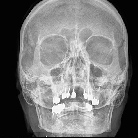 X Ray Nasal Bone AP View Test Price In Delhi Ganesh Diagnostic