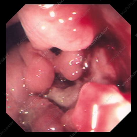 Exactly why does my child have cancer? Colon cancer - Stock Image - M131/0486 - Science Photo Library