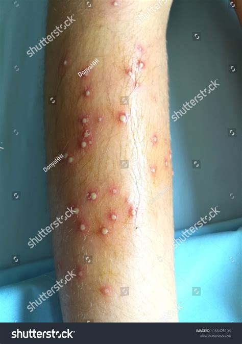 Closeup Picture Skin Infection Called Folliculitis ภาพสต็อก แก้ไข