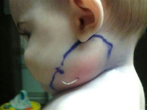 Doctors Find Feather In 7 Month Old Kansas Girls Neck Cbs News