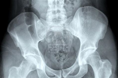 Esclerose óssea Subcondral Aposenta