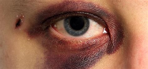 You get a black eye if someone punches you in the eye then it will soon turn black if you are being an idiot, and you tick someone off, they will punch you in what football players put under their eyes that is black is simply called eye black. it is used to reduce glare from the sun, and it can consist of. Simple ways to cure black eye | Best ways to get rid of ...
