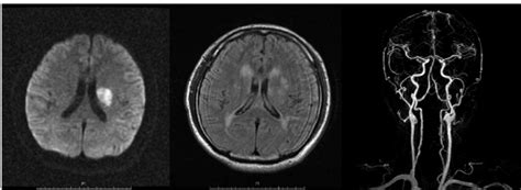 Brain Mri Done One Day After The Onset Of Stroke Brain Mri