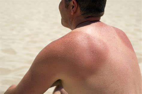 Sunburn Skin Cancer What You Should Know