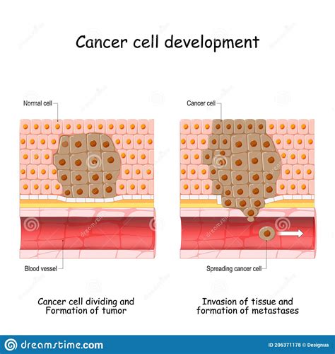 Cancer Cell Development Tumor Formation Stock Vector Illustration Of