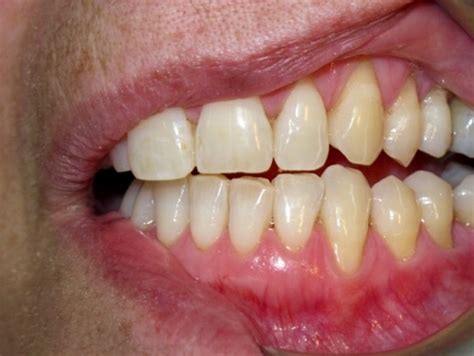 Avoid Gum Recession And Maintain Gum Height With Proper Oral Care