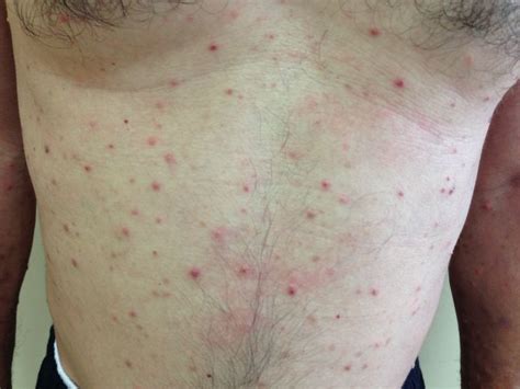 Eosinophilic Pustular Dermatosis With Concomitant Polycytemia Vera A