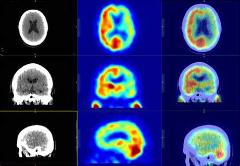 Brain Spect Imaging With Acetazolamide Challenge Journal Of Nuclear