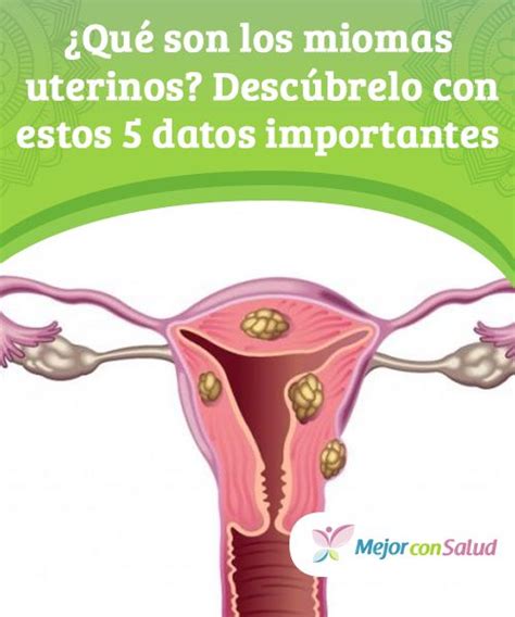 Qué son los miomas uterinos Descúbrelo con estos 5 datos importantes