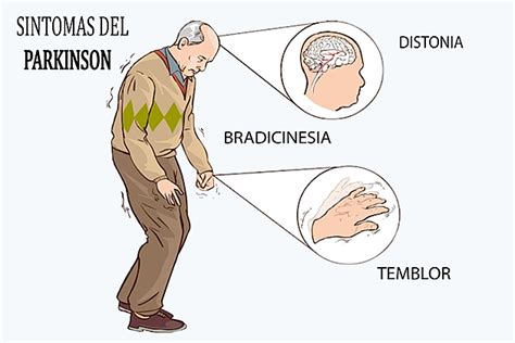 Por el contrario, en el parkinson, el temblor se debe a los ganglios basales, en el cerebelo y el tronco cerebral, según afirma la clínica mayo. La enfermedad del Parkinson, un reto… - Bienestar Vallarta