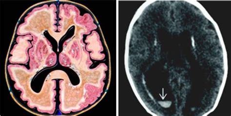 Abnormal Mri Brain Conginental Cmv Radiology Imaging