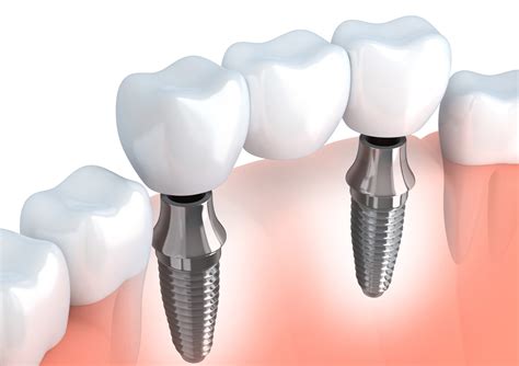 Multiple Tooth Replacement Joondalup | Dental Reflections