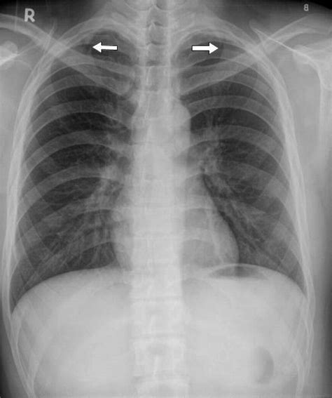 Isolated Bilateral First Rib Fractures Journal Of Emergency Medicine