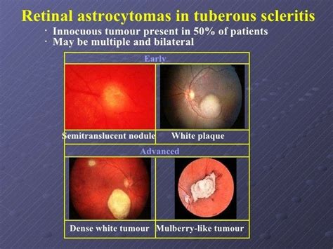 Mulberry Tumor Astrocytic Retinal Hamartomas In Tuberous Sclerosis