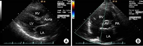 Echocardiography In The Parasternal Long Axis View A And Short Axis