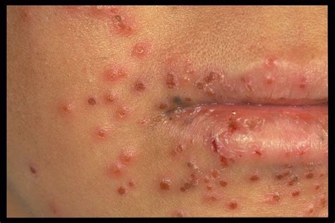 Eczema Herpeticum A Rare Problem Of Atopic Dermatitis When Eczema