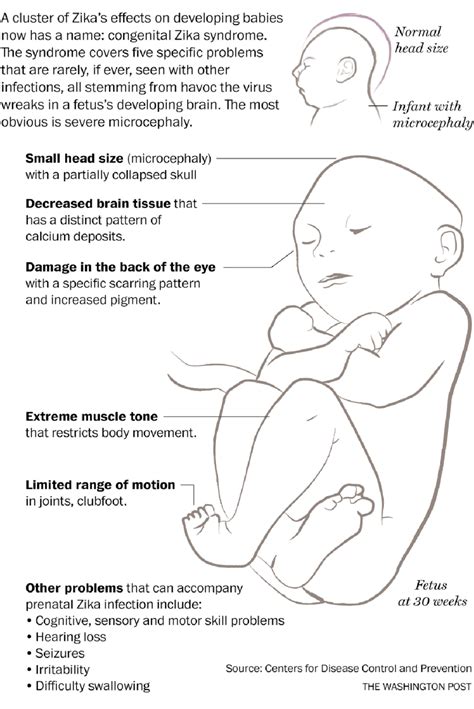 Congenital Zika Syndrome And Other Birth Defects Gynecology Congress