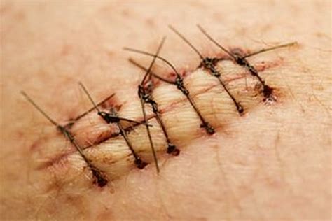 Dissolvable Stitches Features Pictures How They Work