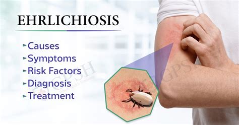 Ehrlichiosis Causes Symptoms Risk Factors Diagnosis And Treatment
