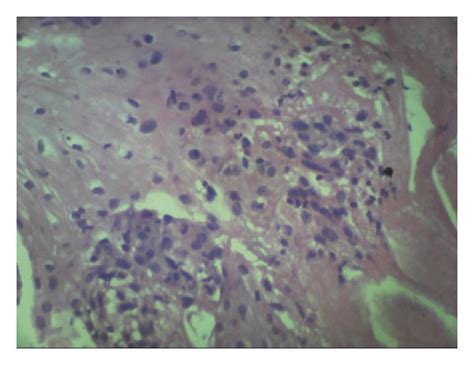 Pathologic Findings Of The Lower Esophagus Revealed Squamous Cell