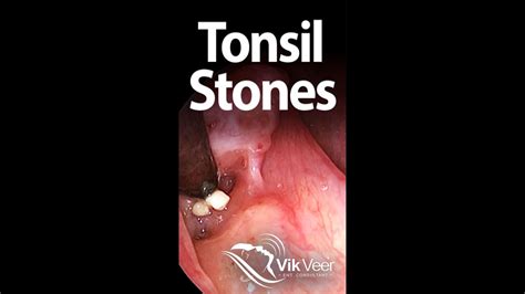 Remove Tonsil Stones London Howotremov