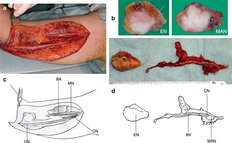 Mid Arm Lymph Nodes Dissection For Melanoma Journal Of Plastic