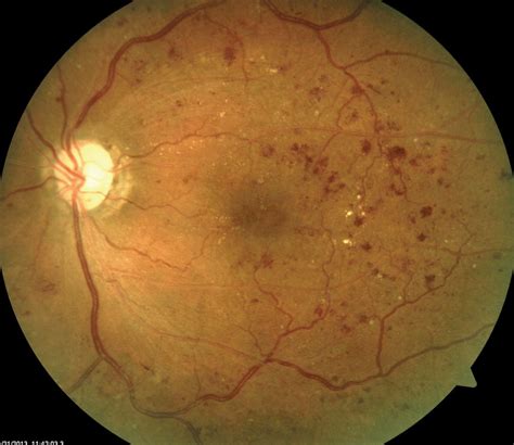 Tiny bulges protrude from the vessel walls, sometimes. My Patient Has Diabetic Retinopathy...Now What?