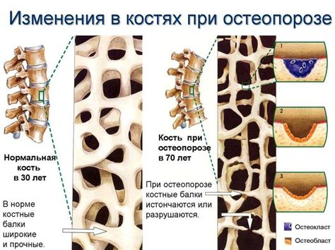 Przyczyny Osteoporozy Rodzaje I Objawy Choroby Metody Jej Leczenia I
