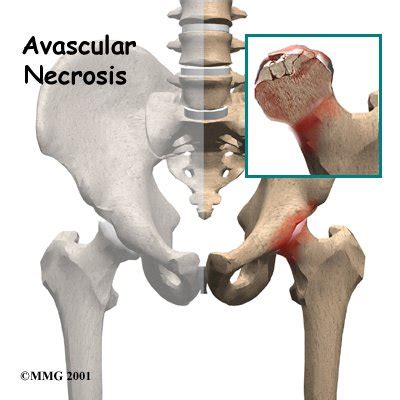 Systemic Lupus Erythematosus Case Study - Physiopedia