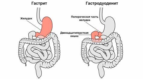 Хронический гастродуоденит диета какая Гастродуоденит что это за болезнь симптомы и причины развития заболевания Гастродуоденит что это за болезнь симптомы и причины развития заболевания Хронический гастродуоденит диета какая