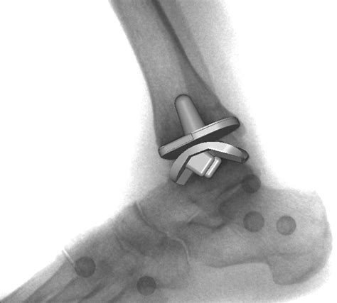 Total Ankle Arthroplasty The Orthopaedic Group Pc
