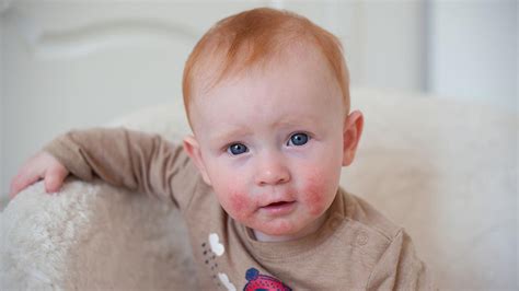 Da diese symptome allerdings nicht eindeutig auf ein atopisches ekzem hindeuten, bietet es sich immer an. Neurodermitis Baby: erste Anzeichen erkennen und richtig ...