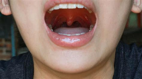 ¿qué Es La Uvulitis Y Por Qué Puede Ocurrir Mejor Con Salud