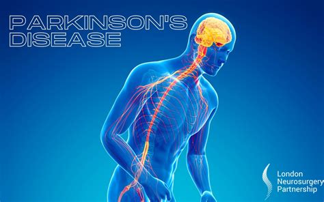 Parkinsons Disease London Neurosurgery Partnership