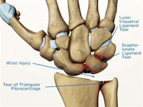 Triangular Fibrocartilage Complex Tfcc Injury Teton Hand Surgery