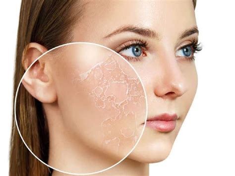 Winter Care For Dry Flaky Skin The Right Care Can Make All The Difference TheHealthSite Com