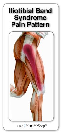 Iliotibial Band Syndrome ITBS