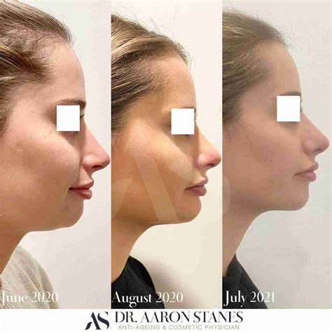 Chin Sculpting Example 4 Dr Aaron Stanes Anti Ageing And Cosmetic