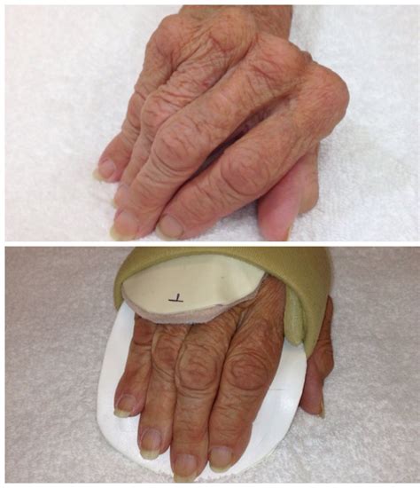 Custom Splint For Rheumatoid Arthritis To Help Align The Hand And