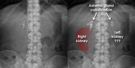 Abdominal X Ray Gallery Calcification Adrenal Calcification