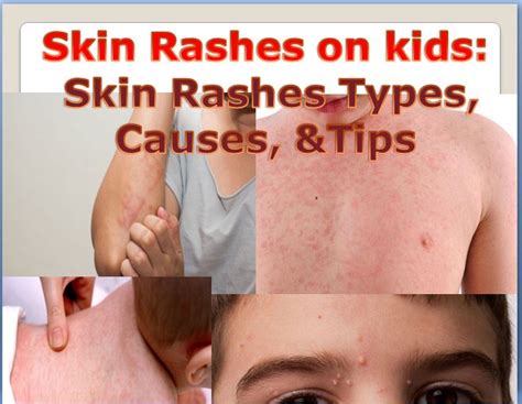 Skin Rashes On Kids Skin Rashes Types Causes And Tips In Children