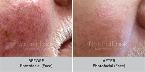 Ipl Photofacial For Rosacea Modern Aesthetic Centers Gate Parkway