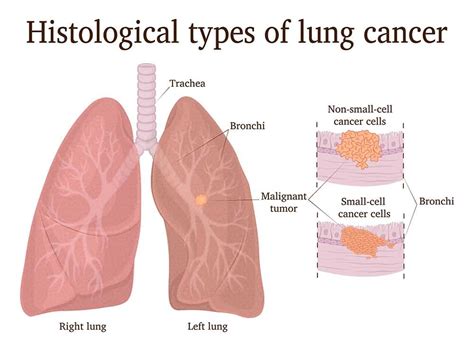 Lung cancer is a group of diseases defined by what type of lung tissue the abnormal cells originated in. Lung Cancer; Types, Causes, Symptoms, Diagnosis & Treatment