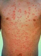 Dermatologo a Lucca : La Psoriasi Guttata